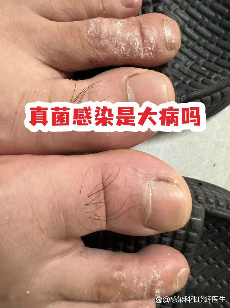 真菌和細菌感染哪個更嚴重，真菌和細菌感染哪個更嚴重真菌和細菌感染哪個更嚴重 真菌和細菌感染哪個更嚴重，真菌和細菌感染哪個更嚴重真菌和細菌感染哪個更嚴重 龍魚百科 第2張