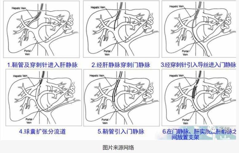 腹水病如何治療，干預腹水病治療 腹水病如何治療，干預腹水病治療 龍魚百科 第5張