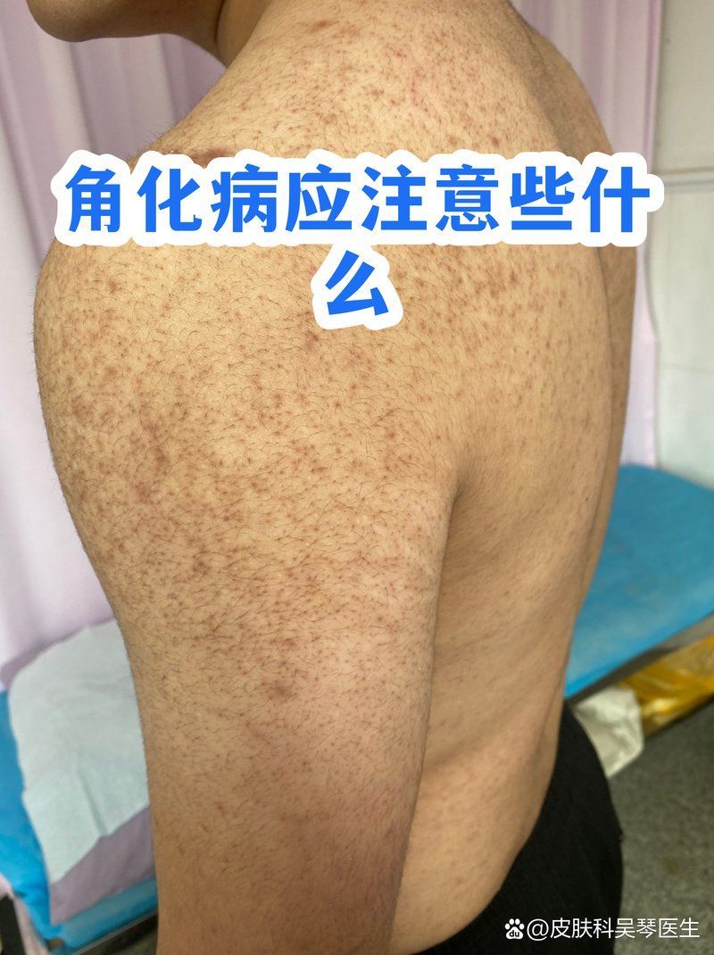 炸鱗病康復(fù)后如何護(hù)理，關(guān)于炸鱗?。~(yú)鱗病）康復(fù)后護(hù)理