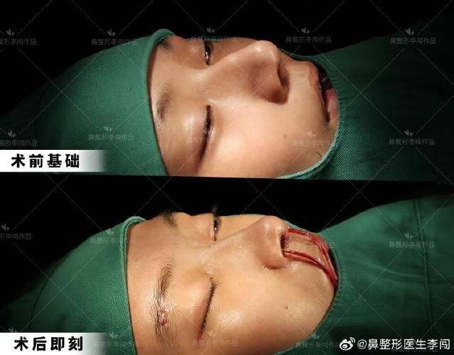 如何判斷龍魚是否需要手術磨骨？，如何判斷“龍魚是否需要手術磨骨”