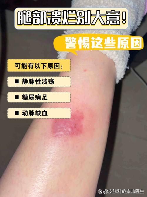 如何區(qū)分細菌性和真菌性潰爛，如何區(qū)分細菌性與真菌性潰爛