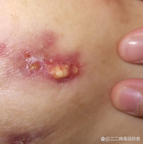 如何區(qū)分細菌性和真菌性潰爛，如何區(qū)分細菌性與真菌性潰爛