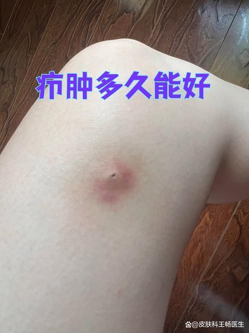 如何區(qū)分細菌性和真菌性潰爛，如何區(qū)分細菌性與真菌性潰爛