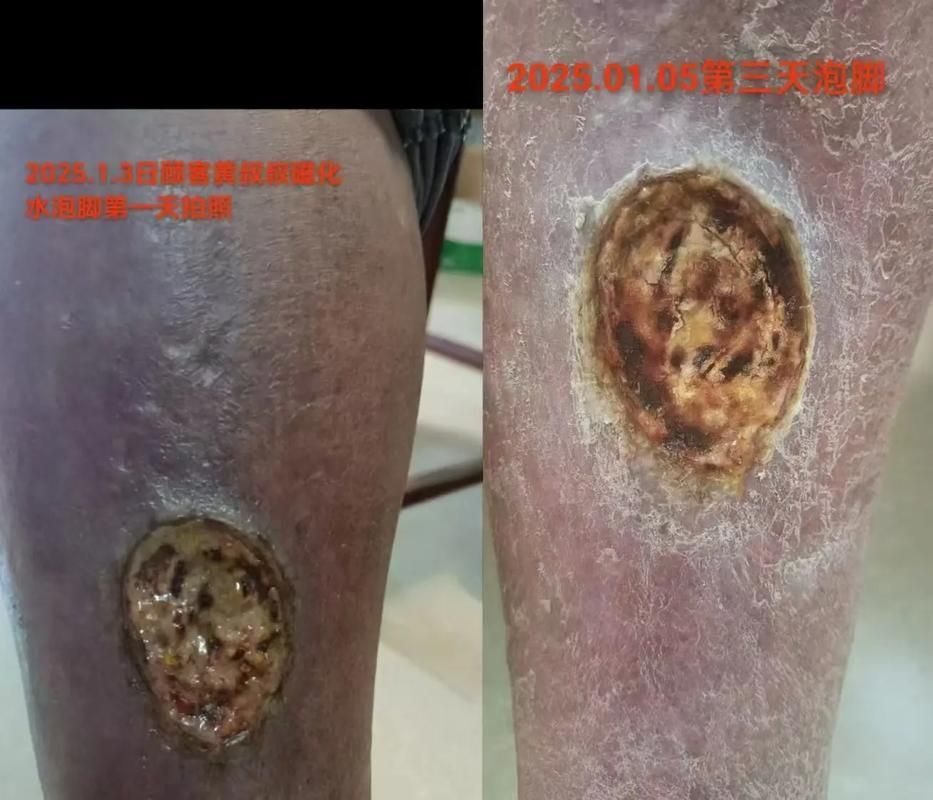 如何區(qū)分細菌性和真菌性潰爛，如何區(qū)分細菌性與真菌性潰爛