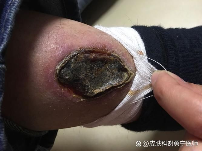 如何區(qū)分細菌性和真菌性潰爛，如何區(qū)分細菌性與真菌性潰爛