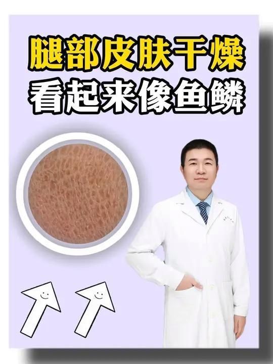 魚鱗病患者如何保持皮膚濕潤，魚鱗病患者保持皮膚濕潤是關(guān)鍵 魚鱗病患者如何保持皮膚濕潤，魚鱗病患者保持皮膚濕潤是關(guān)鍵 龍魚百科 第2張