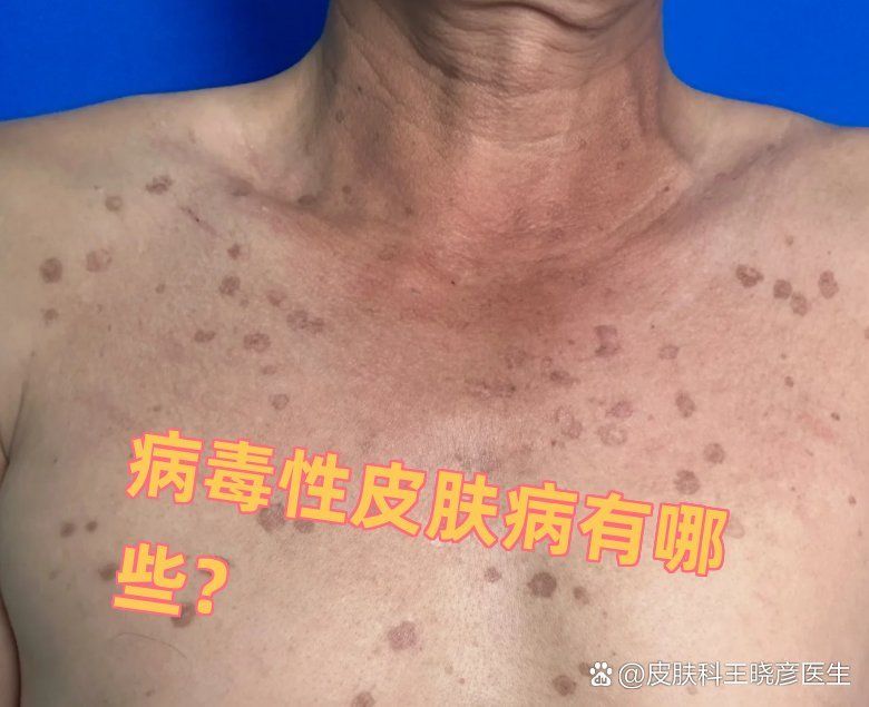 如何區分細菌性和病毒性爛身，如何區分細菌性和病毒性“爛身” 如何區分細菌性和病毒性爛身，如何區分細菌性和病毒性“爛身” 龍魚百科 第1張