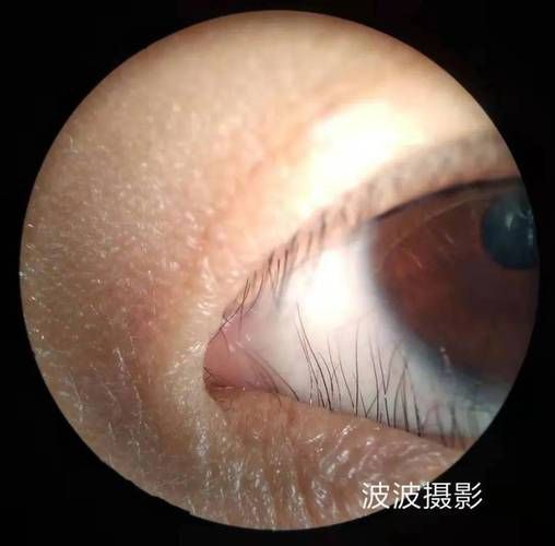 如何區(qū)分不同類(lèi)型的眼部混濁，如何區(qū)分玻璃體混濁 如何區(qū)分不同類(lèi)型的眼部混濁，如何區(qū)分玻璃體混濁 龍魚(yú)百科 第2張