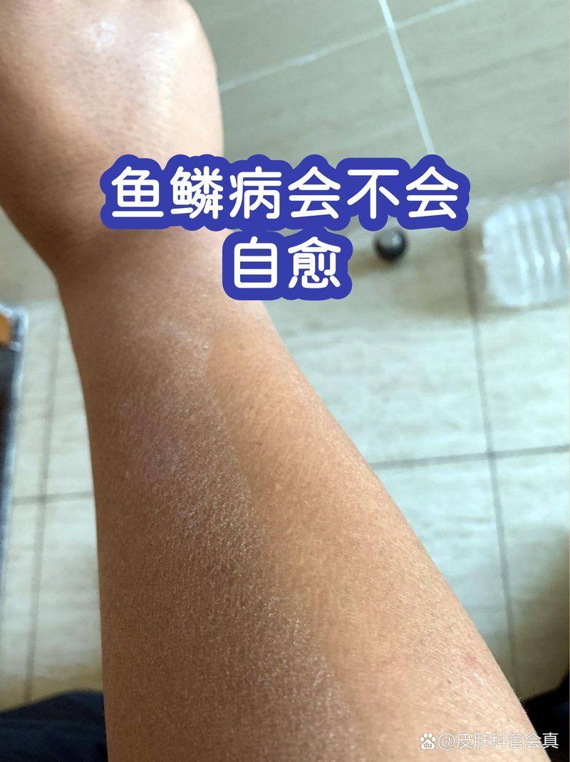如何判斷魚(yú)鱗病是否自愈，如何判斷魚(yú)鱗病是否自愈調(diào)用工具百度健康-去問(wèn)診