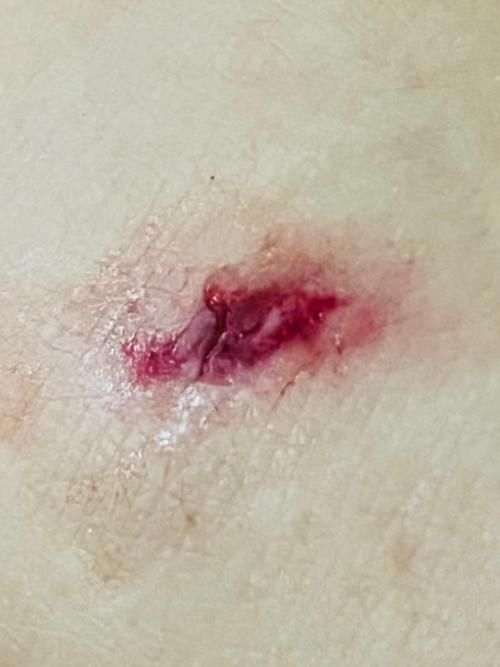 手被龍魚咬了后多久會愈合，手被龍魚咬了后中國臨床愈合與用工具