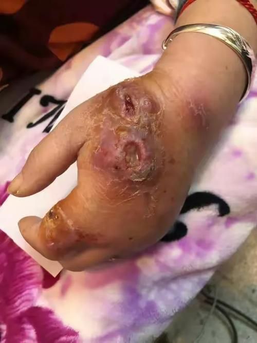 如何判斷自己是否感染了魚缸細菌，如何判斷自己是否感染了魚缸細菌思考完成魚缸細菌思考完成