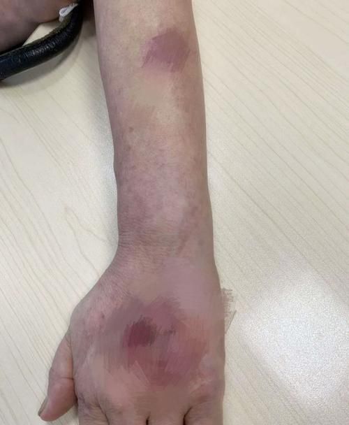 如何判斷自己是否感染了魚缸細菌，如何判斷自己是否感染了魚缸細菌思考完成魚缸細菌思考完成
