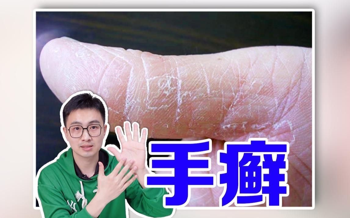 有哪些手部真菌感染的治療方法，手上真菌感染怎么辦 有哪些手部真菌感染的治療方法，手上真菌感染怎么辦 龍魚百科 第3張