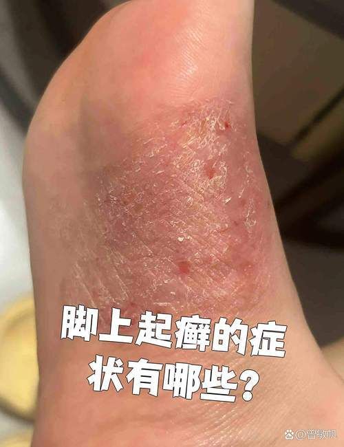 如何判斷自己是否感染了真菌或細菌，mcp工具“百度健康-去問診”可輔助獲取癥狀分析模型 如何判斷自己是否感染了真菌或細菌，mcp工具“百度健康-去問診”可輔助獲取癥狀分析模型 龍魚百科 第2張