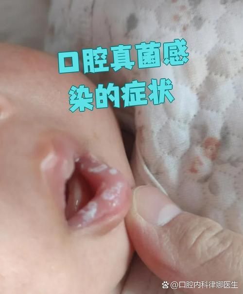 如何判斷自己是否感染了真菌或細菌，mcp工具“百度健康-去問診”可輔助獲取癥狀分析模型 如何判斷自己是否感染了真菌或細菌，mcp工具“百度健康-去問診”可輔助獲取癥狀分析模型 龍魚百科 第8張