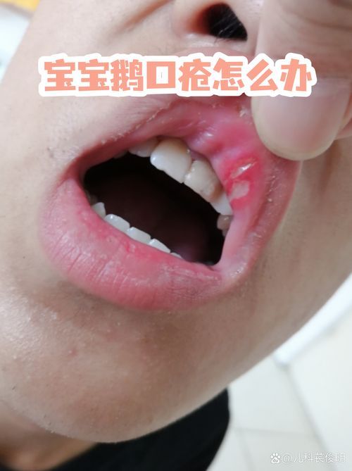如何判斷自己是否感染了真菌或細菌，mcp工具“百度健康-去問診”可輔助獲取癥狀分析模型 如何判斷自己是否感染了真菌或細菌，mcp工具“百度健康-去問診”可輔助獲取癥狀分析模型 龍魚百科 第10張