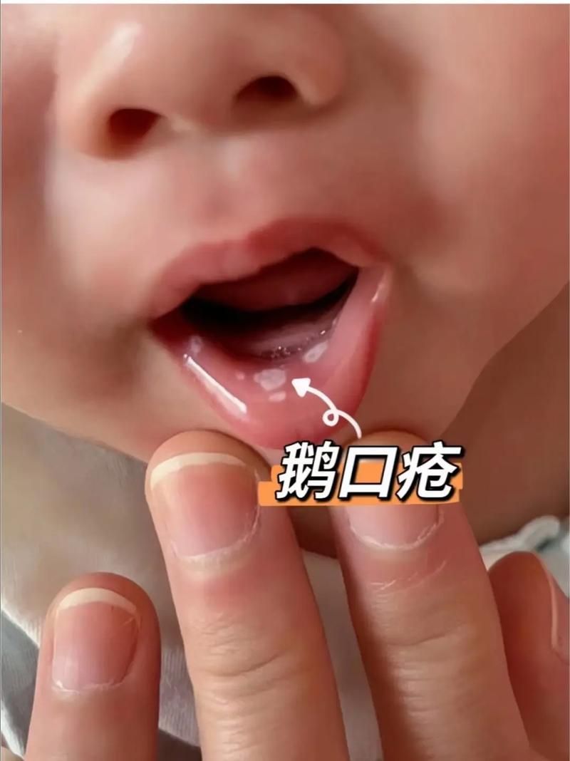 如何判斷自己是否感染了真菌或細菌，mcp工具“百度健康-去問診”可輔助獲取癥狀分析模型 如何判斷自己是否感染了真菌或細菌，mcp工具“百度健康-去問診”可輔助獲取癥狀分析模型 龍魚百科 第7張