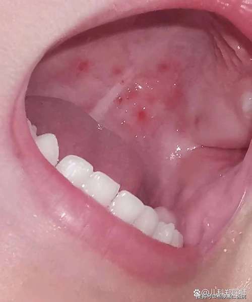 如何判斷自己是否感染了真菌或細菌，mcp工具“百度健康-去問診”可輔助獲取癥狀分析模型 如何判斷自己是否感染了真菌或細菌，mcp工具“百度健康-去問診”可輔助獲取癥狀分析模型 龍魚百科 第11張