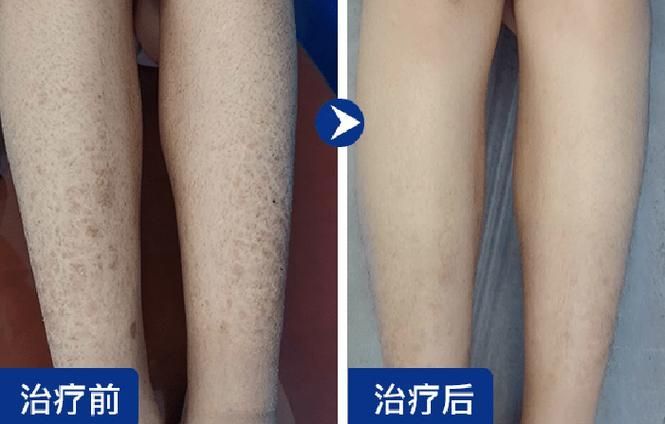 如何判斷魚鱗病是否加重，如何判斷凡士林+醫(yī)用敷料加重 如何判斷魚鱗病是否加重，如何判斷凡士林+醫(yī)用敷料加重 龍魚百科 第2張