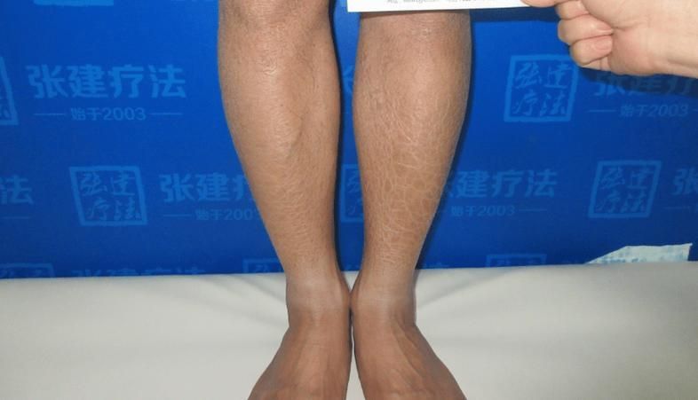 如何判斷魚鱗病是否加重，如何判斷凡士林+醫(yī)用敷料加重 如何判斷魚鱗病是否加重，如何判斷凡士林+醫(yī)用敷料加重 龍魚百科 第6張