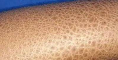給我一些魚鱗病的圖片示例，如何判斷自己是否患有魚鱗病 給我一些魚鱗病的圖片示例，如何判斷自己是否患有魚鱗病 龍魚百科 第2張