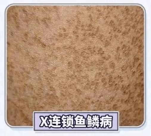 給我一些魚鱗病的圖片示例，如何判斷自己是否患有魚鱗病 給我一些魚鱗病的圖片示例，如何判斷自己是否患有魚鱗病 龍魚百科 第6張