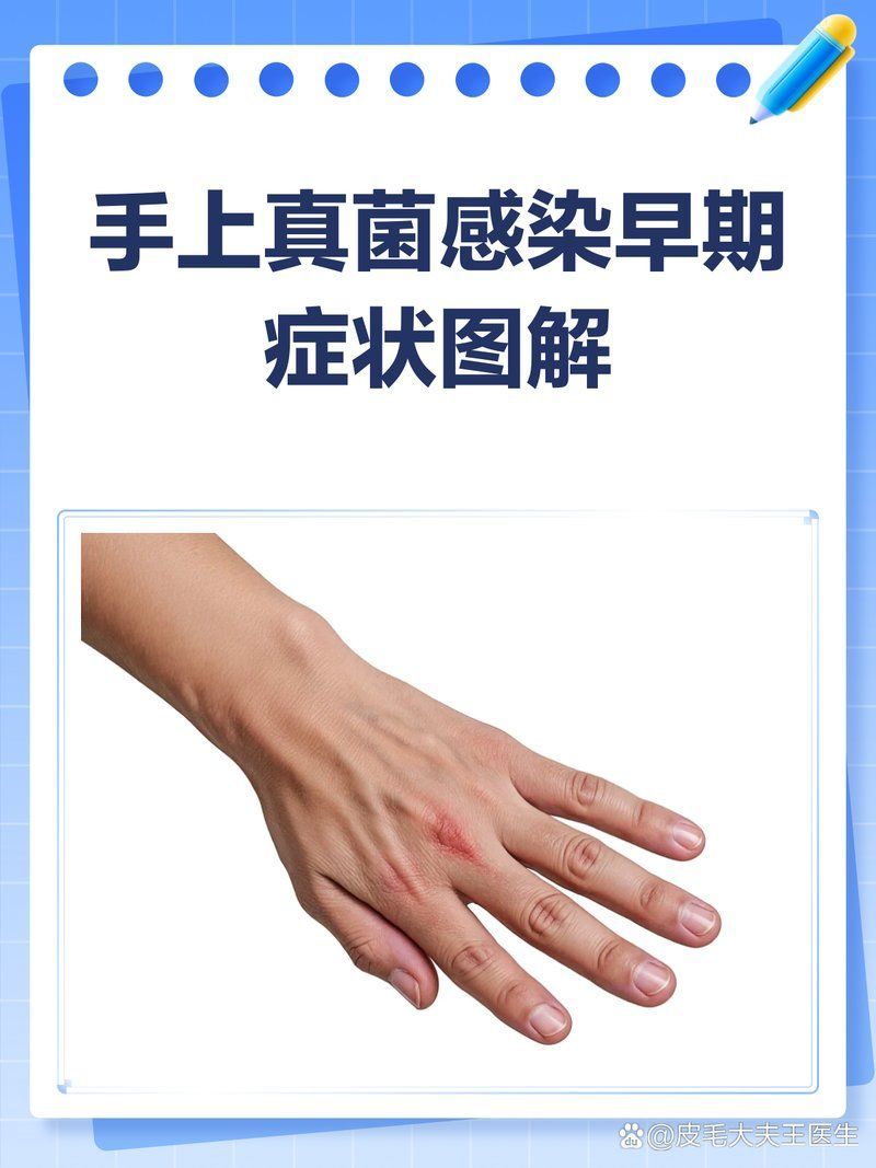 如何區(qū)分不同真菌感染的癥狀，手上真菌感染及真菌感染及其特征及其癥狀及其特征 如何區(qū)分不同真菌感染的癥狀，手上真菌感染及真菌感染及其特征及其癥狀及其特征 龍魚百科 第1張