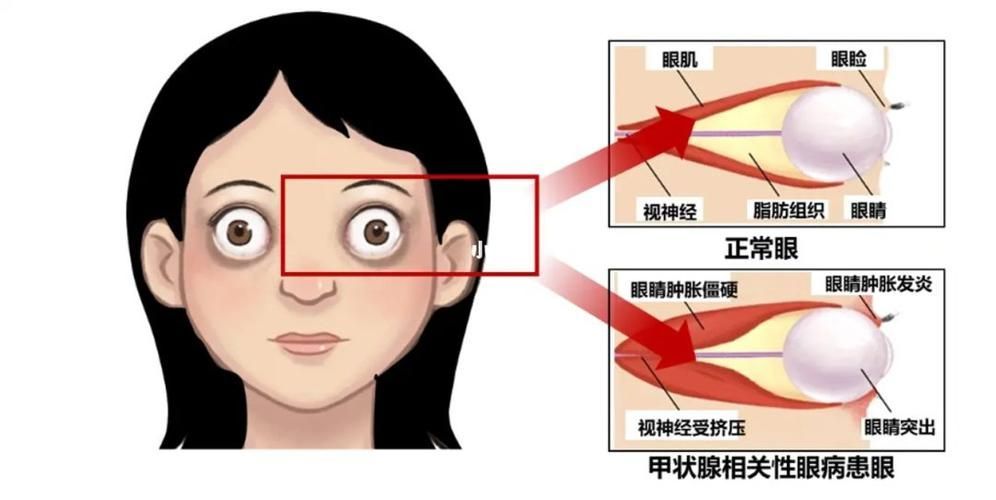 有哪些藥物可以幫助治療魚突眼,“魚突眼”并非醫學標準術語可以幫助治療魚突眼ted 龍魚百科 第5張 有哪些藥物可以幫助治療魚突眼,“魚突眼”并非醫學標準術語可以幫助治療魚突眼ted 有哪些藥物可以幫助治療魚突眼,“魚突眼”并非醫學標準術語可以幫助治療魚突眼ted 龍魚百科 第5張
