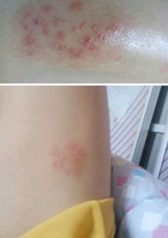 詳細閱讀:能否提供更多早期癥狀的圖片,早期癥狀的識別與分析 能否提供更多早期癥狀的圖片,早期癥狀的識別與分析