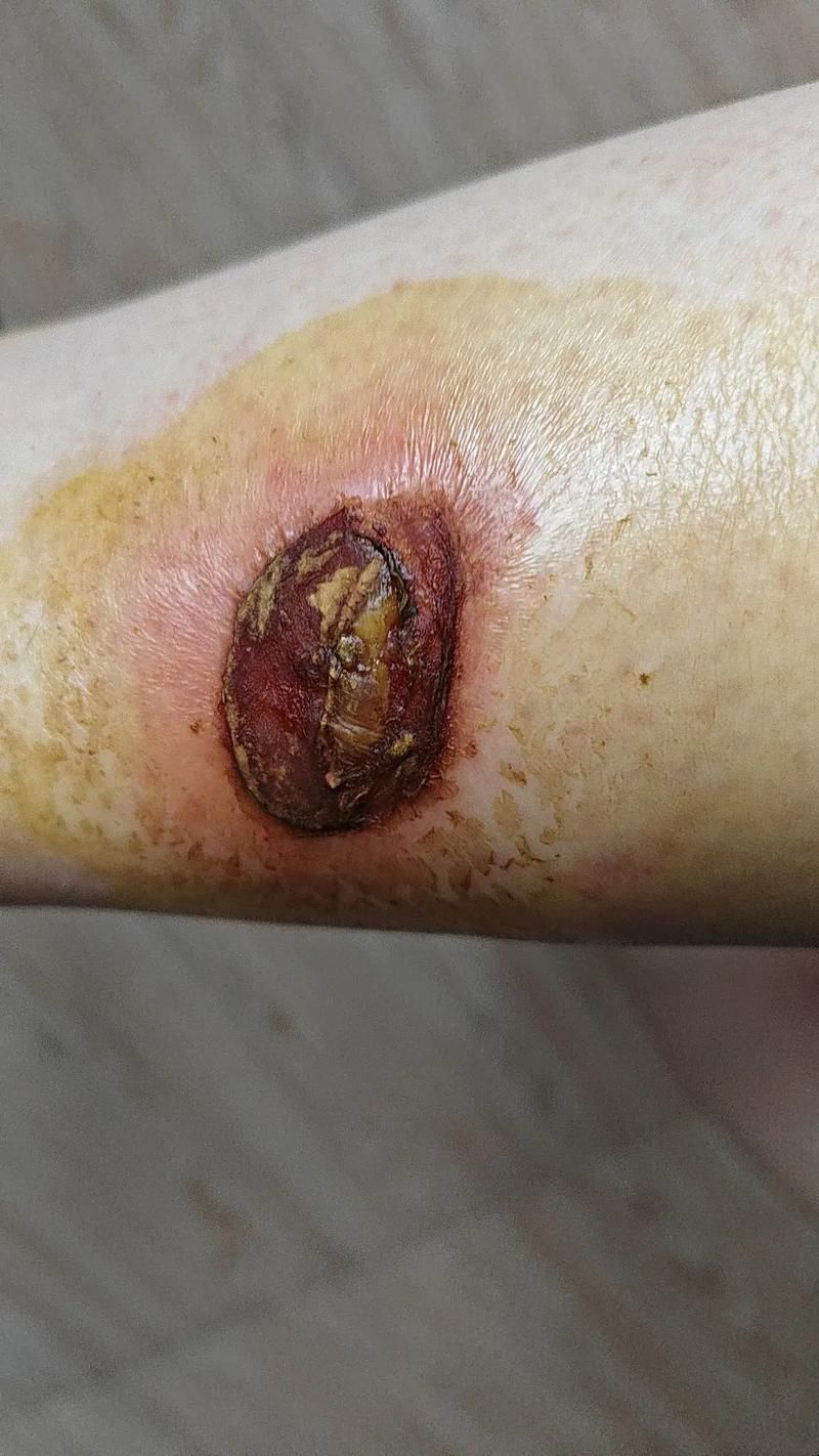 被龍魚咬傷后多久會愈合，被龍魚咬傷后多久會愈合思考完成百度健康-去問診