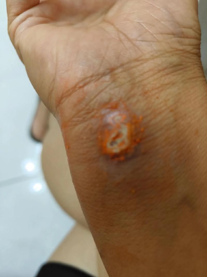 被龍魚咬傷后多久會愈合，被龍魚咬傷后多久會愈合思考完成百度健康-去問診