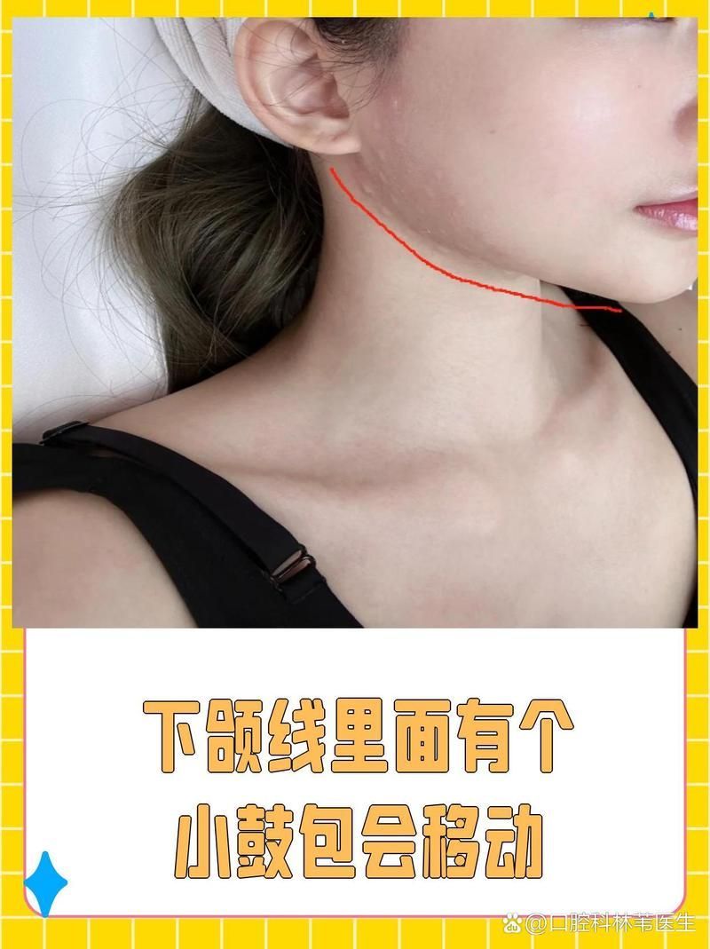 病理性下顎鼓起如何治療，病理性下顎鼓起如何治療病理性下顎鼓起如何治療
