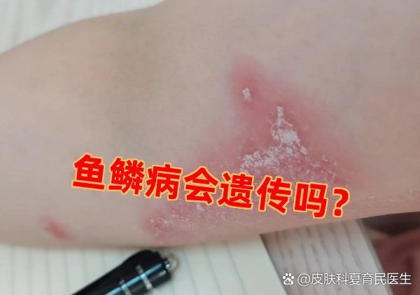 魚(yú)鱗病患者可以結(jié)婚生子嗎，魚(yú)鱗病患者可以結(jié)婚生子嗎魚(yú)鱗病患者可以結(jié)婚生子嗎