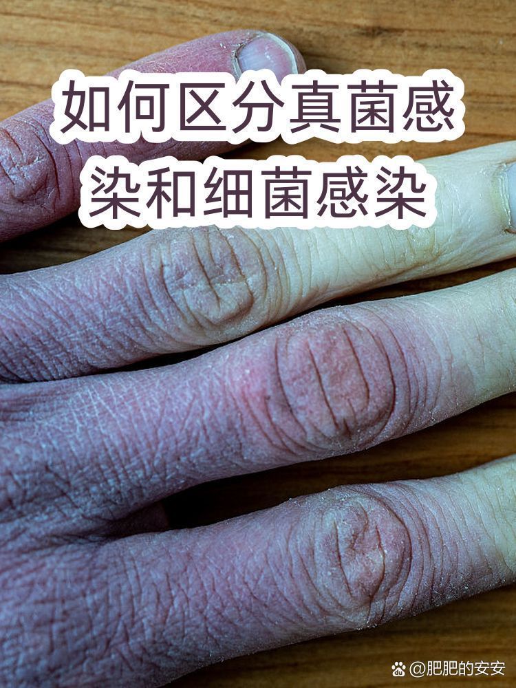 怎么判斷是真菌還是細菌，判斷真菌或細菌通常需要觀察其形態特征、培養特性和生理反應