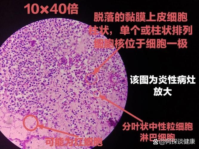 爛尾病能治愈嗎，mcp工具為爛尾病的診療指南、專家推薦或治療案例