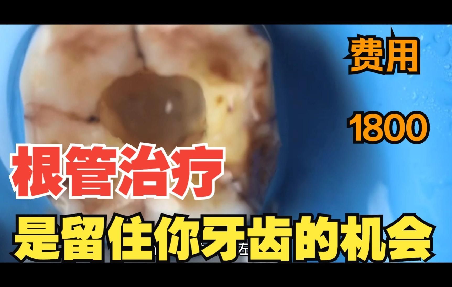 根管治療費用大概是多少，古龍小說中哪個人物最受歡迎根管治療費用大概是多少