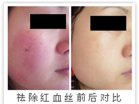 紅血絲簡(jiǎn)單去除方法，去紅血絲前后對(duì)比圖