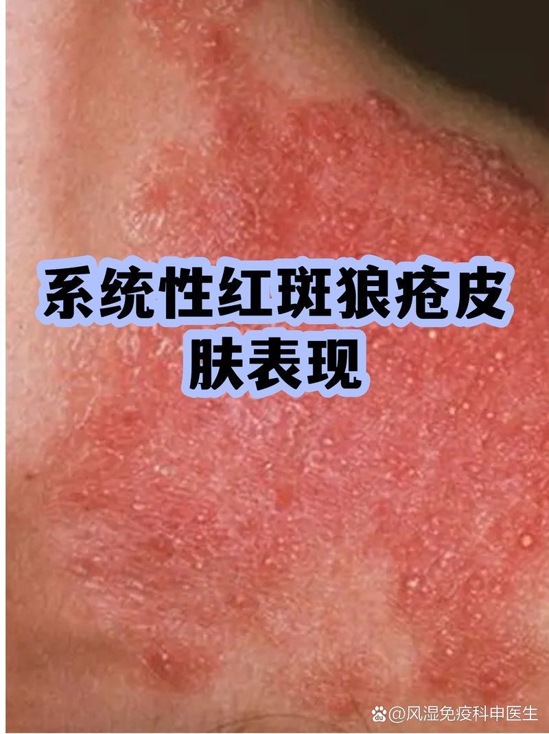 紅斑病和赤皮病如何治療，紅斑病與赤皮病的區別