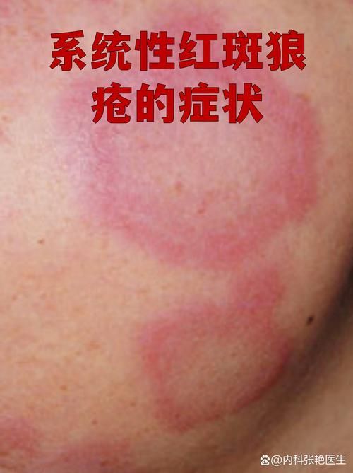 紅斑病和赤皮病如何治療，紅斑病與赤皮病的區別