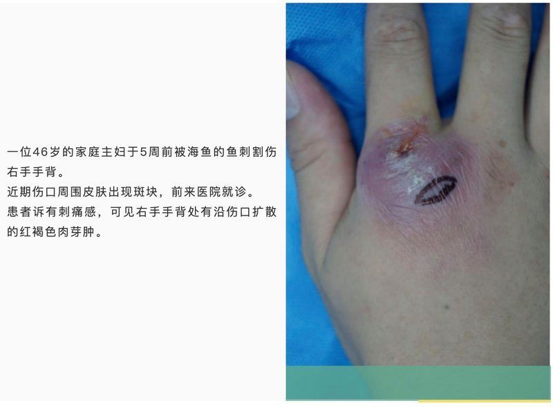 如何預防魚尾巴感染，如何預防“魚尾巴感染”