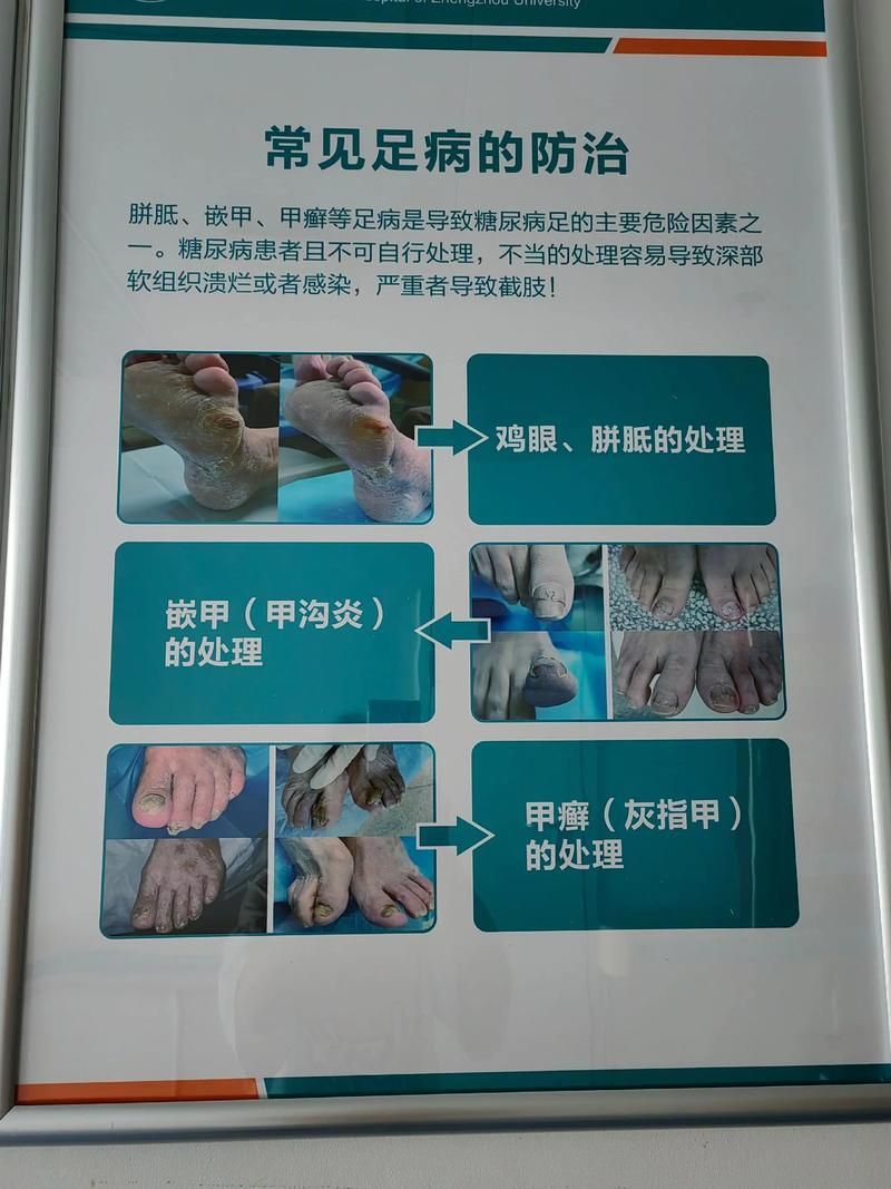 如何預防爛身病，權威醫學指南中關于“爛身病”的預防措施（如cdc、mayoclinic）