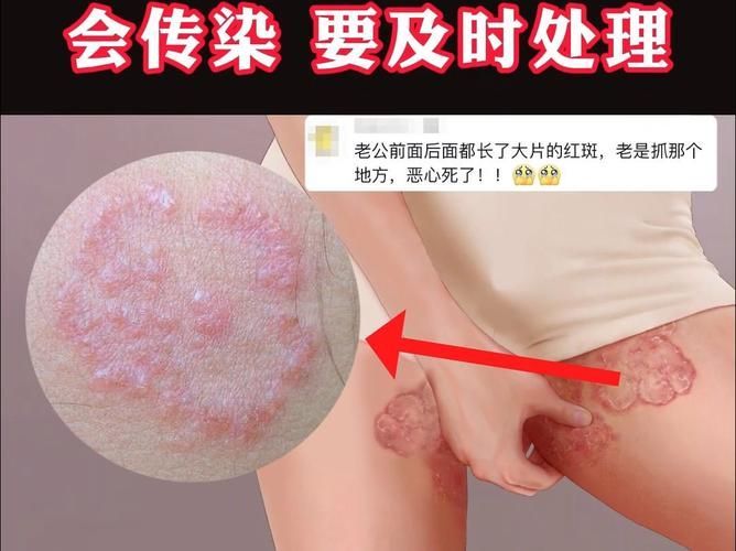 能否提供更多真菌和細(xì)菌感染的典型圖片，如何區(qū)分真菌和細(xì)菌感染