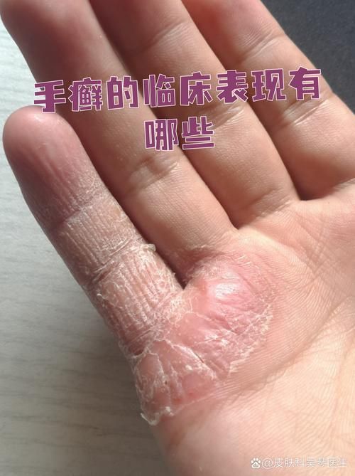 能否提供更多真菌和細(xì)菌感染的典型圖片，如何區(qū)分真菌和細(xì)菌感染