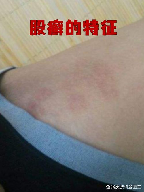 能否提供更多真菌和細(xì)菌感染的典型圖片，如何區(qū)分真菌和細(xì)菌感染