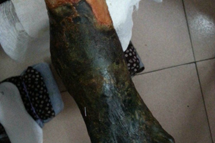 細菌感染型發黑有哪些特點，細菌感染型發黑