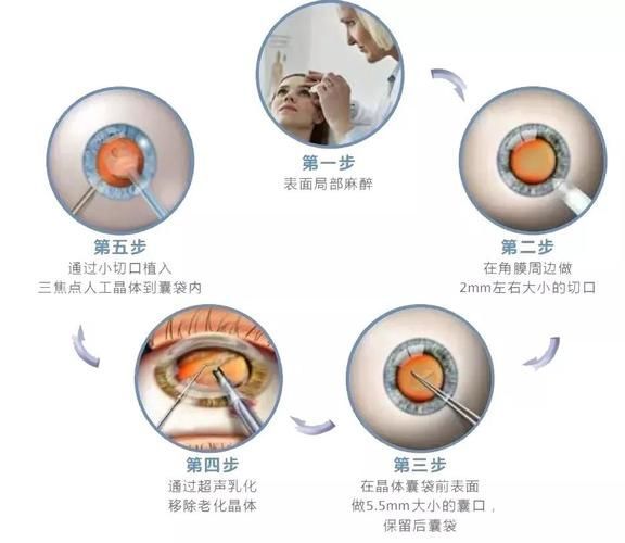 治療蒙眼病需要多長時間，三甲醫院眼科專家治療“蒙眼病”需要多長時間和配圖