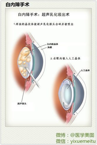 治療蒙眼病需要多長時間，三甲醫院眼科專家治療“蒙眼病”需要多長時間和配圖