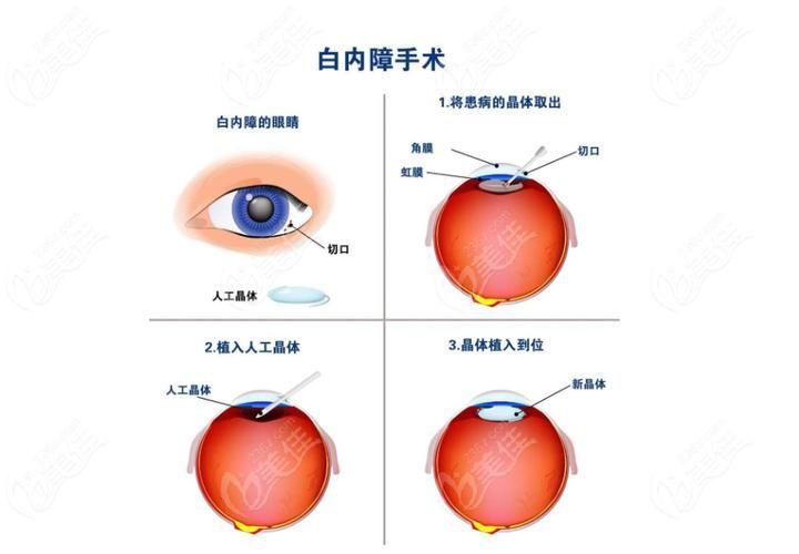 治療蒙眼病需要多長時間，三甲醫院眼科專家治療“蒙眼病”需要多長時間和配圖