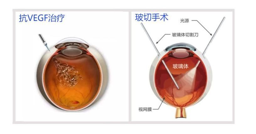治療蒙眼病需要多長時間，三甲醫院眼科專家治療“蒙眼病”需要多長時間和配圖
