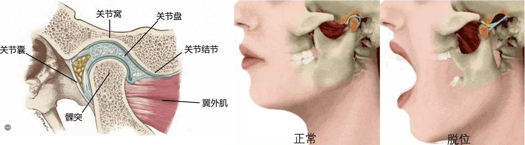 如何判斷龍魚下巴脫臼是否需要手術